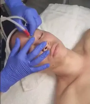 Medical Grade | Sterile Crystal Microdermabrasion with Chemical Peel